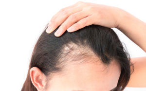 как лечить выпадение волос