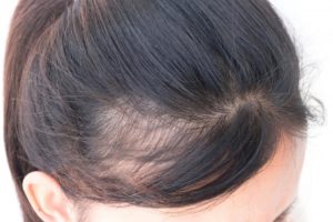 как лечить выпадение волос