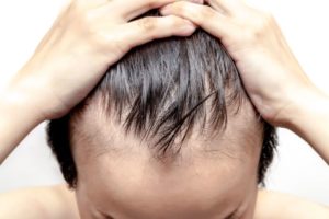 выпадение волос у мужчин в 20 лет