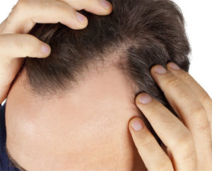 из за чего выпадают волосы у мужчин