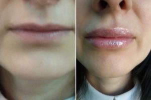 губы после гиалуронки